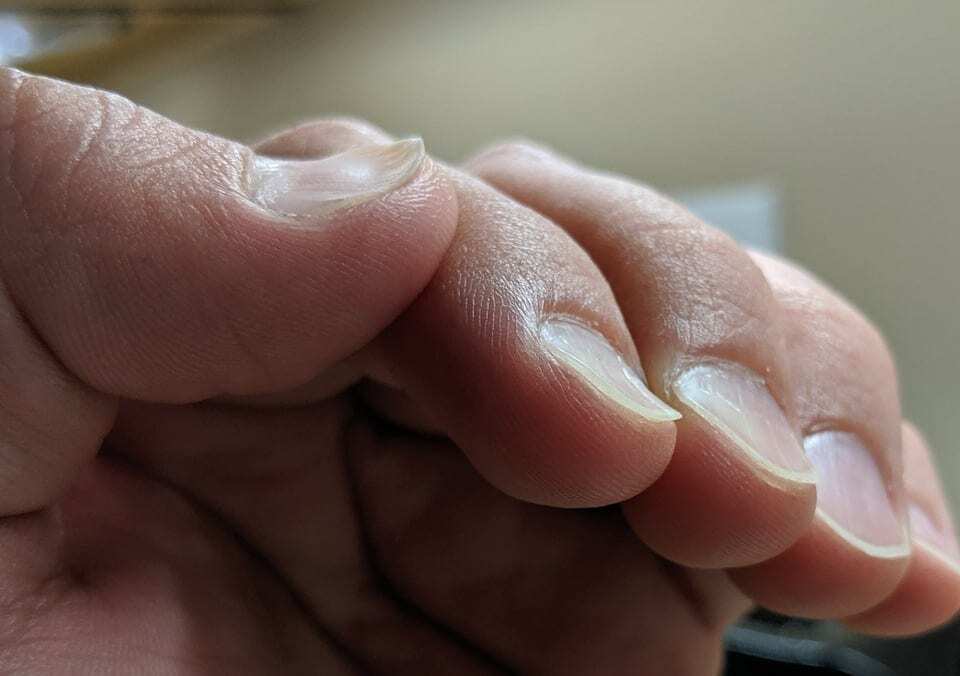 «У моего мужа редкая генетическая мутация, из-за которой его ногти растут перевёрнутыми»