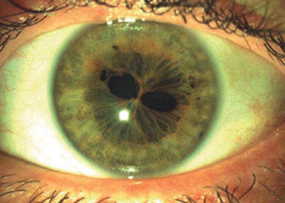Человеческий глаз с поликорией (множественными зрачками)