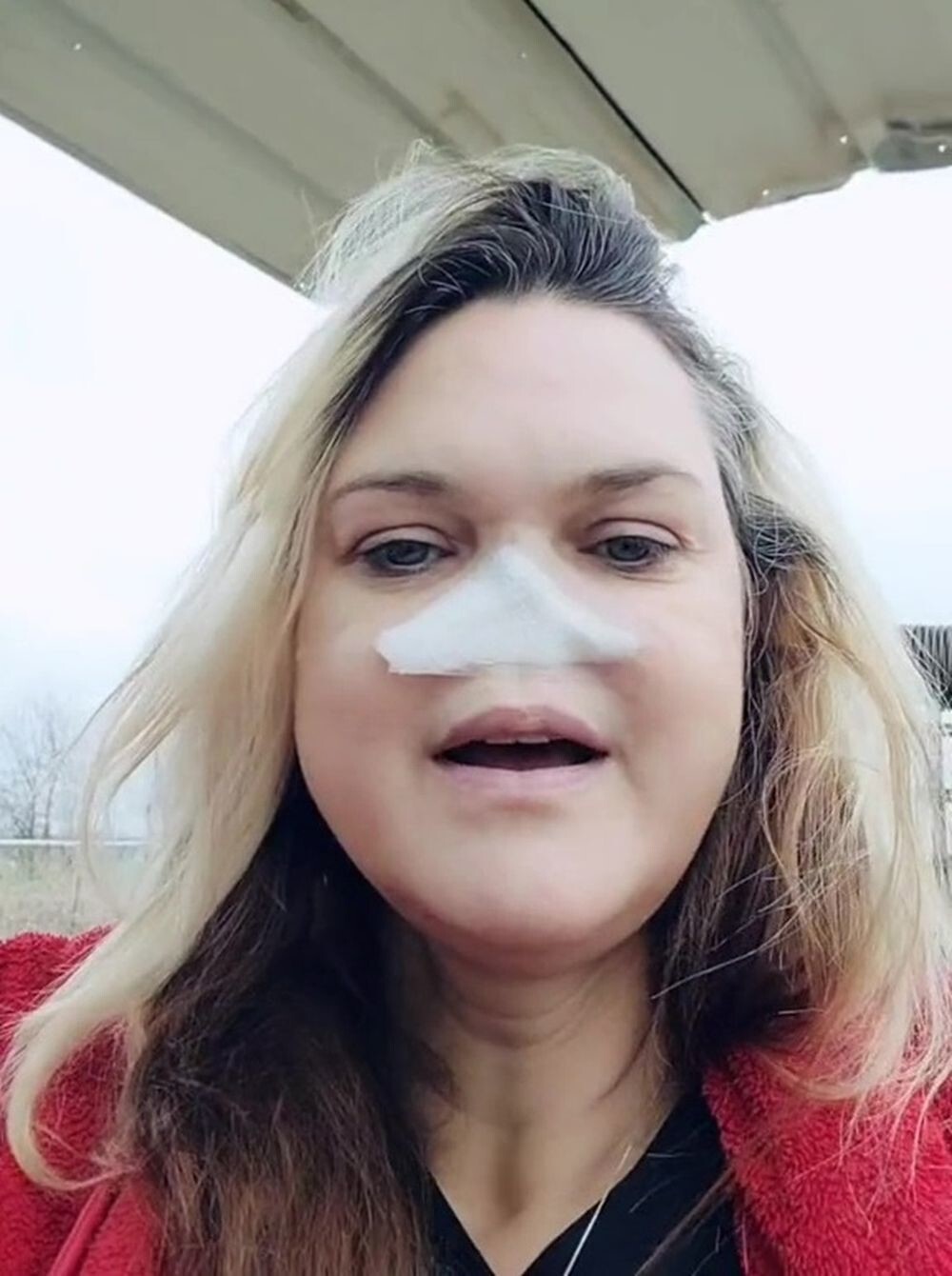 Лишившаяся носа женщина решила отказаться от протеза