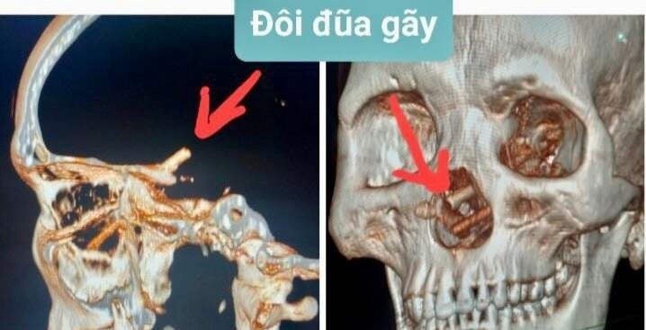 Вьетнамец жаловался на головную боль и не знал, что носит в черепе палочки для еды