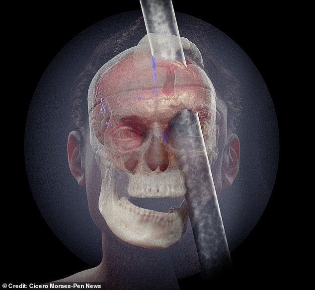 Учёные показали  лицо Финеаса Гейджа через мгновение после несчастного случая