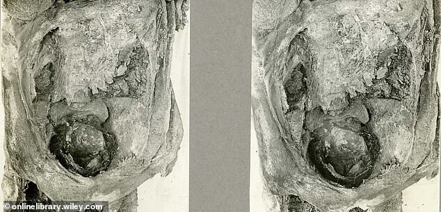 Внутри древнеегипетской мумии нашли нерожденных близнецов