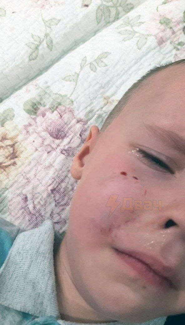 В Краснодаре бойцовская собака накинулась на ребёнка в лифте и укусила его за лицо
