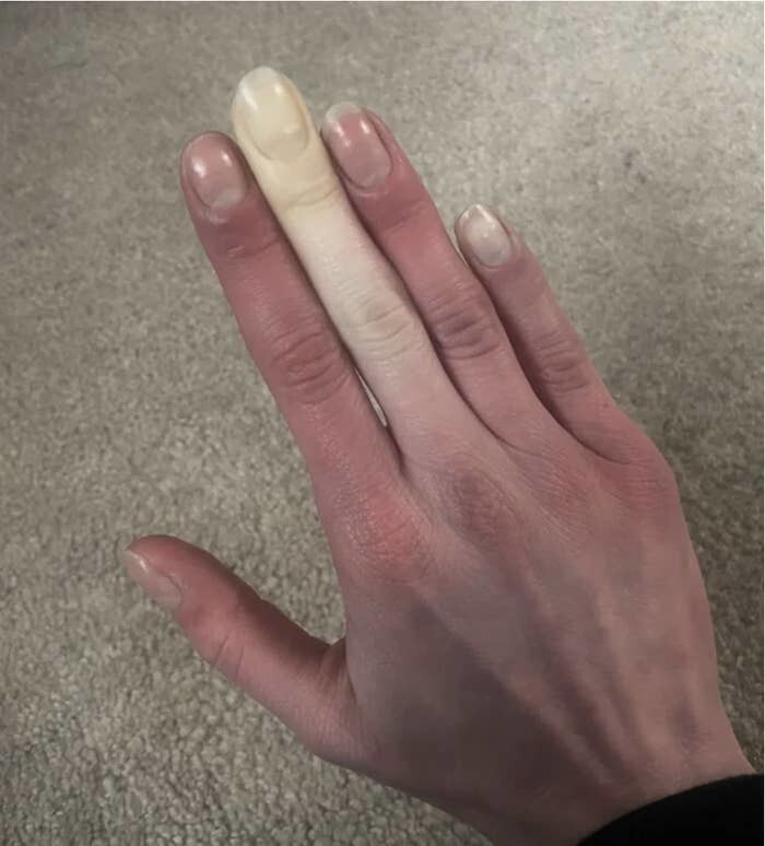 3. Болезнь Рейно - изменение цвета кожи пальцев кистей и стоп в ответ на низкую температуру окружающей среды