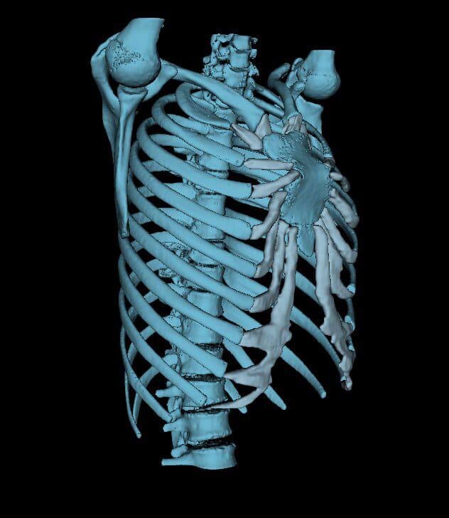 3D-моделирование помогло хирургам выполнить редчайшую операцию на грудную клетку⁠⁠