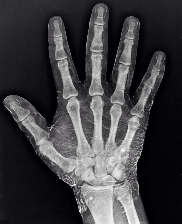 3. Так будет выглядеть рентгеновский снимок руки, на которую нанесён йод