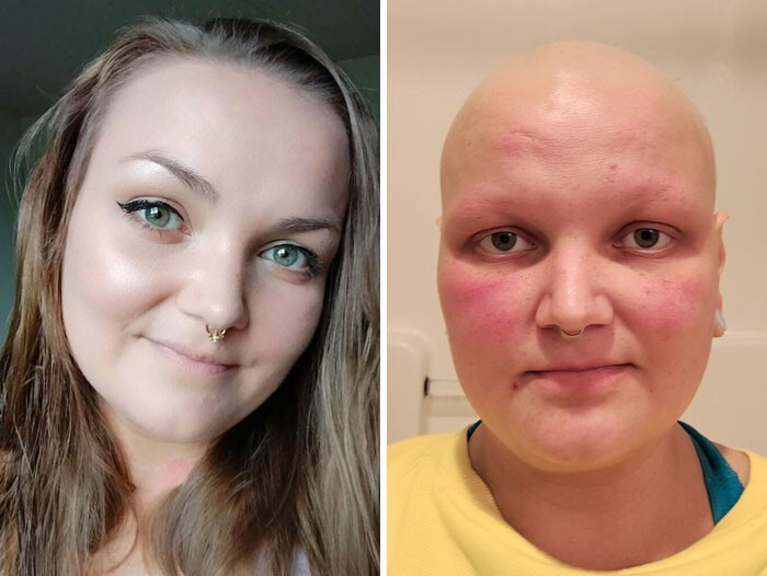 12. До и после химиотерапии