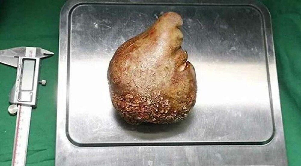 21. Самый большой в мире камень в почке удалили у пациента из Шри-Ланки. Камень весил 757,5 г, и побил два мировых рекорда