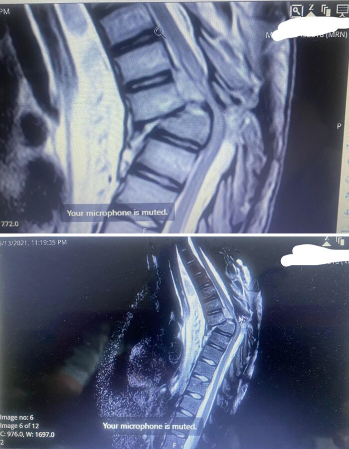 16. «Мой рентгеновский снимок после перелома спины»