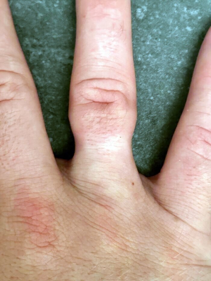 26. "Мой палец после того, как я снял кольцо, которое носил не снимая 2,5 года"