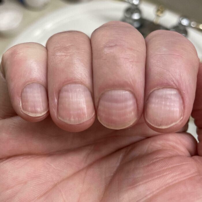 5. 6 линий на моих ногтях, по одной на каждый сеанс химиотерапии, которые я недавно прошла