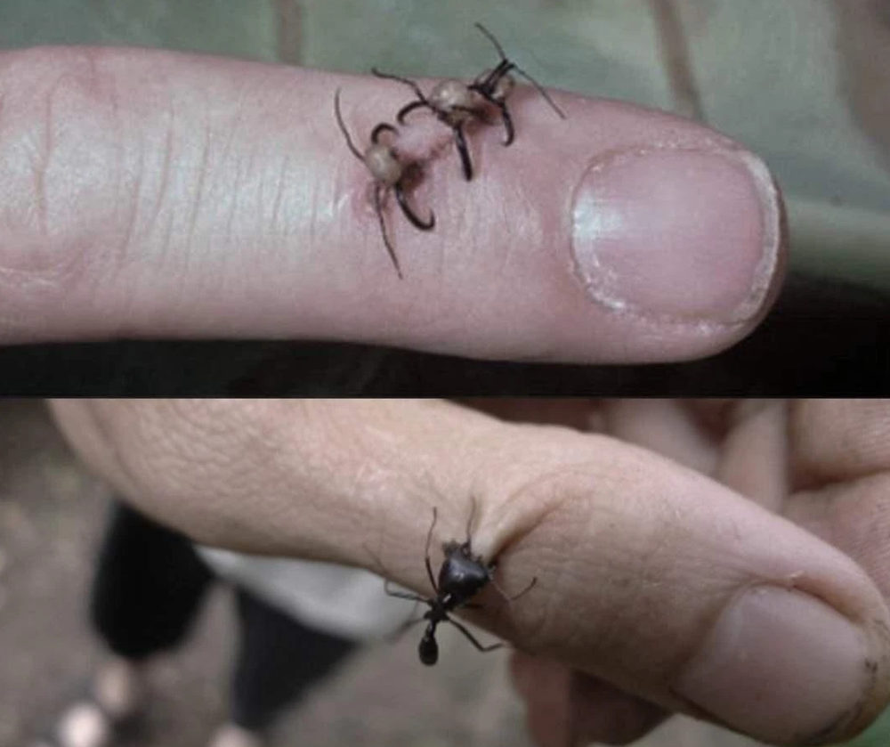 2. В некоторых культурах в прошлом использовали разъяренных муравьев рода Dorylus для зашивания ран. В настоящее время эту практику продолжают применять в центральной и восточной Африке
