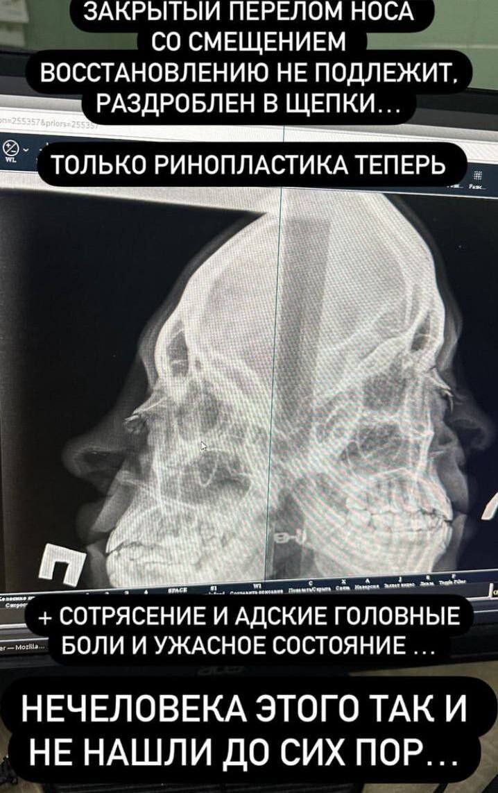 В Челябинске мужик, которого не пустили в бар, от обиды сломал нос девушке и сбежал