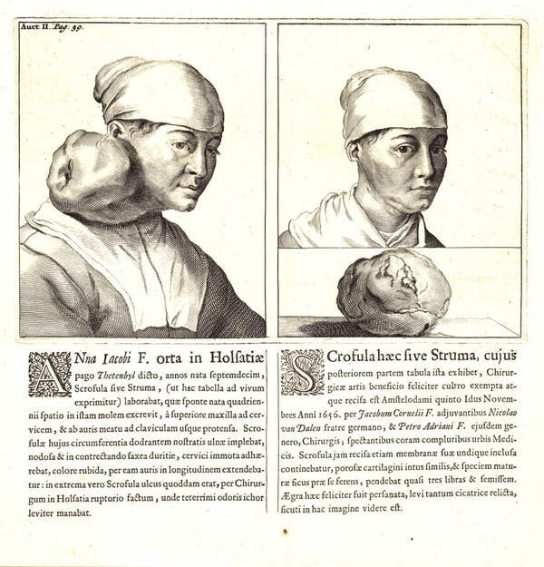 7. Старый медицинский журнал, в котором изображена пациентка до и после удаления опухоли в XVII веке