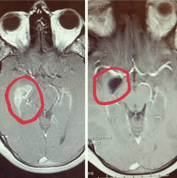 8. МРТ мозга человека до и после операции по удалению опухоли в височной доле