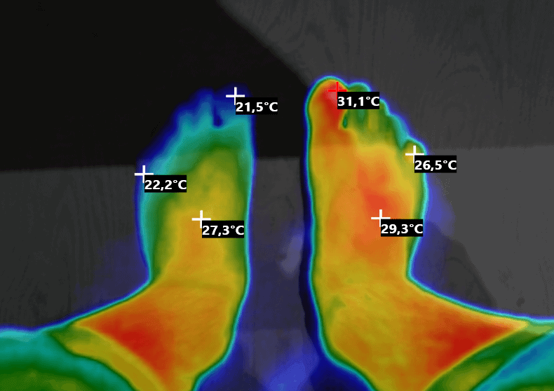 Тепловизор показывает разницу температур между нормальной стопой и стопой с вросшим ногтем
