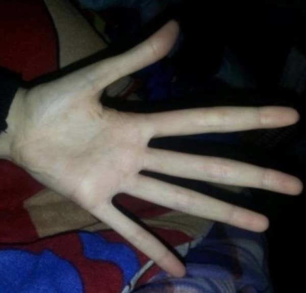 2. Рука человека с синдромом Марфана (заболевание, связанное с соединительной тканью). У людей с этим синдромом, как правило, очень длинные пальцы и конечности