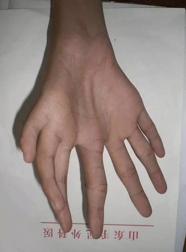 18. Яркий пример полидактилии (когда имеются лишние пальцы на руках или ногах)