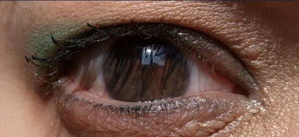10. Так выглядит глаз без зрачка. Отсутствие радужной оболочки глаза называется аниридией. Чаще всего это врожденная патология