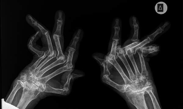 6. Вот рентгеновский снимок, показывающий, насколько тяжелым может быть артрит