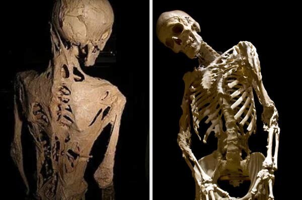 13. Одно из самых страшных заболеваний — fibrodysplasia ossificans progressiva, «синдром каменного человека», при котором скелетные мышцы и соединительная ткань медленно превращаются в кости, а суставы начинают срастаться