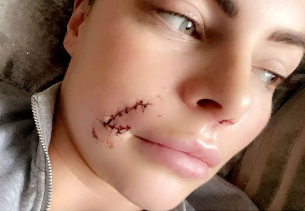 Собака напала на женщину и изуродовала ей лицо
