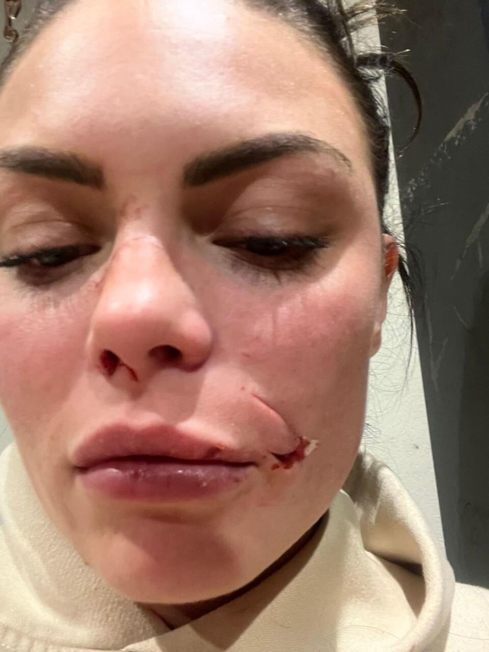 Собака напала на женщину и изуродовала ей лицо