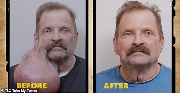 Чудесное превращение: до и после операции по удалению опухоли на лице