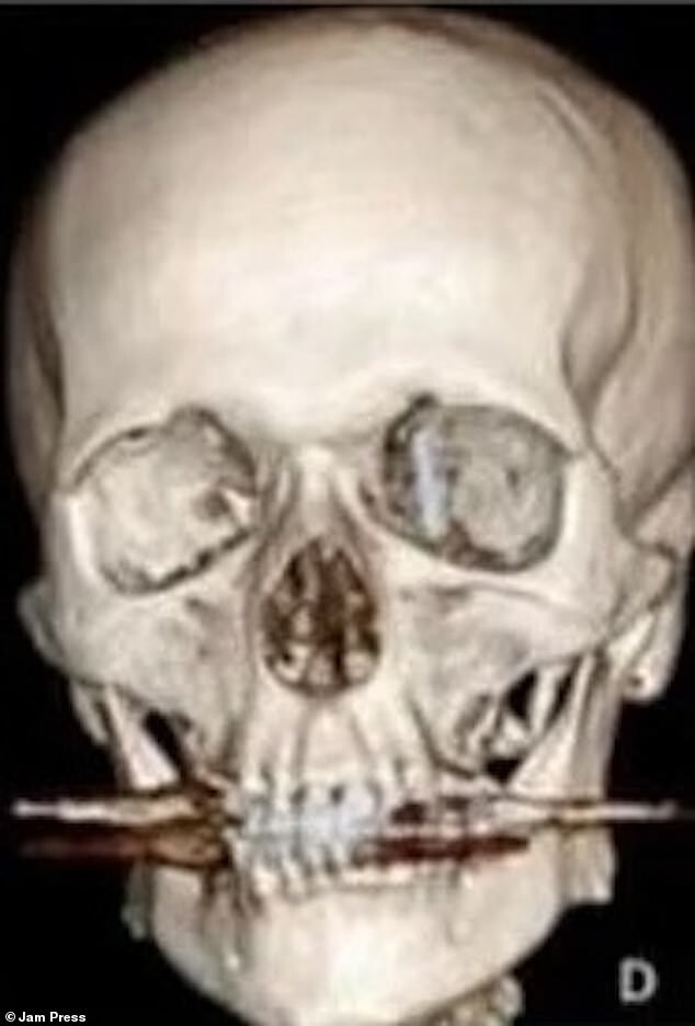 В Турции стоматолог вкрутил зубной имплант в полость мозга пациента и сбежал