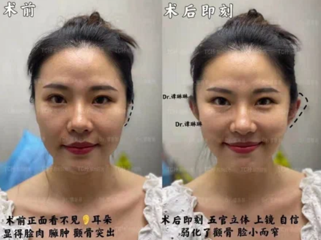 Китайцы делают себе оттопыренные эльфийские уши