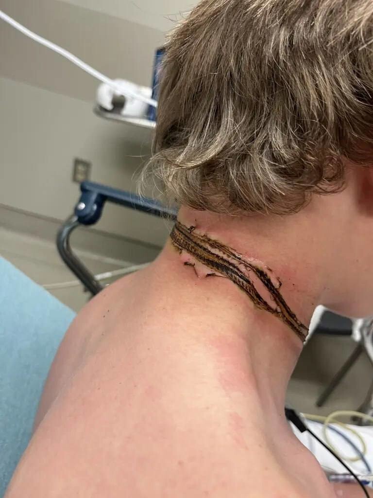 Подросток уснул с цепочкой на шее рядом с зарядкой и получил удар током