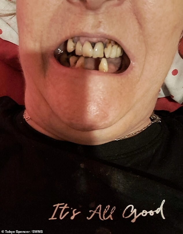 Женщина не дождалась врача и сама себе вырвала зуб плоскогубцами