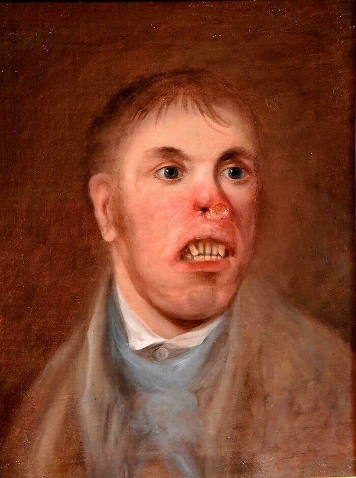 27. Портрет мужчины, страдающего врождённым сифилисом. 1820 год