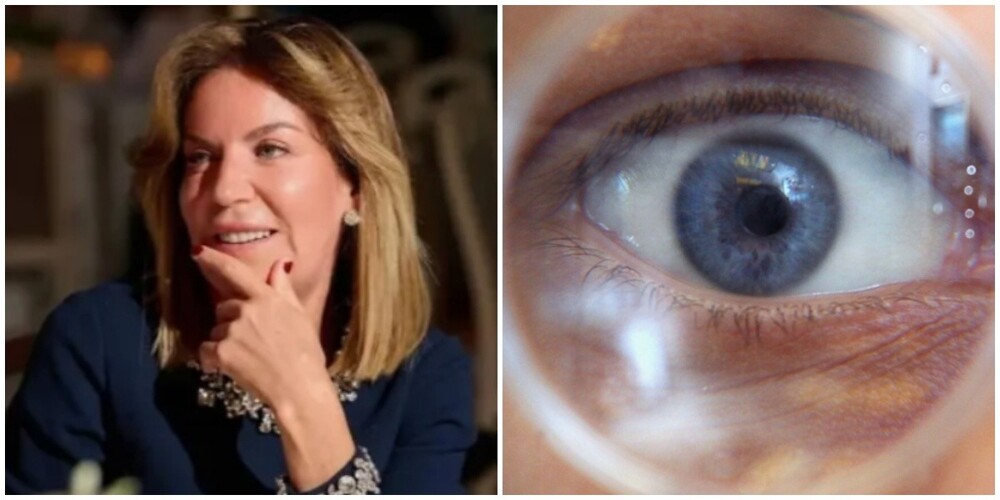 Жена президента Федерации еврейских общин ослепла на оба глаза из-за пластической операции