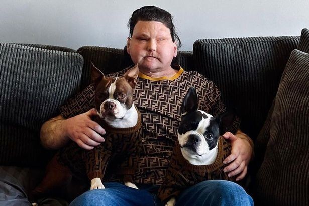 Мужчина после пересадки лица показал, узнали ли его собственные собаки