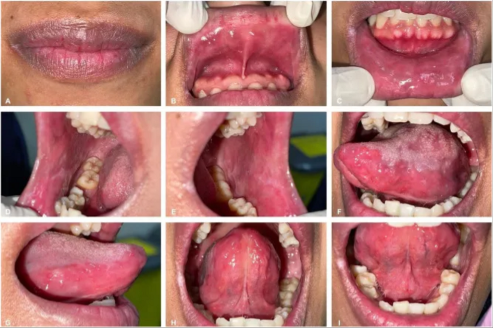 22-летняя девушка за год курения вейпа получила язвы во рту