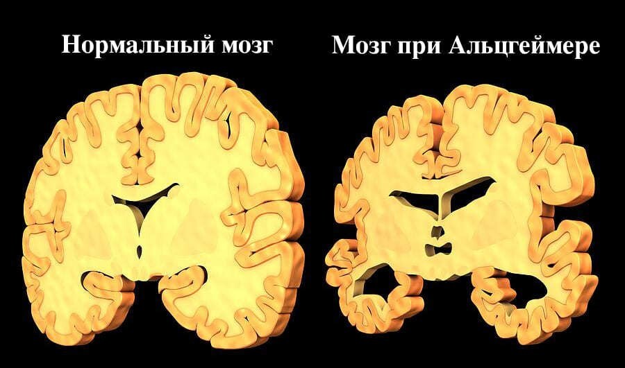 Как заранее определить одну из самых медленно развивающихся болезней