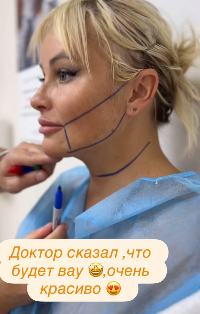 «Похожа на маму Стифлера»: Дана Борисова сделала пластику лица