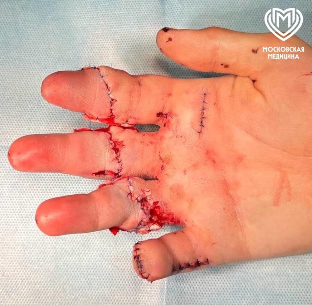 21-летнему парню пришили пальцы, которых он лишился под прессом на производстве⁠⁠