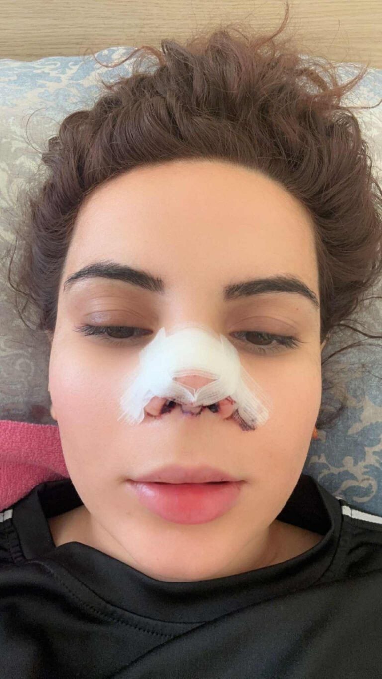 Девушка лишилась возможности нормально дышать из-за неудачной пластики Девушка лишилась возможности нормально дышать из-за неудачной пластики