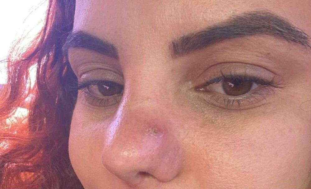 Девушка лишилась возможности нормально дышать из-за неудачной пластики Девушка лишилась возможности нормально дышать из-за неудачной пластики