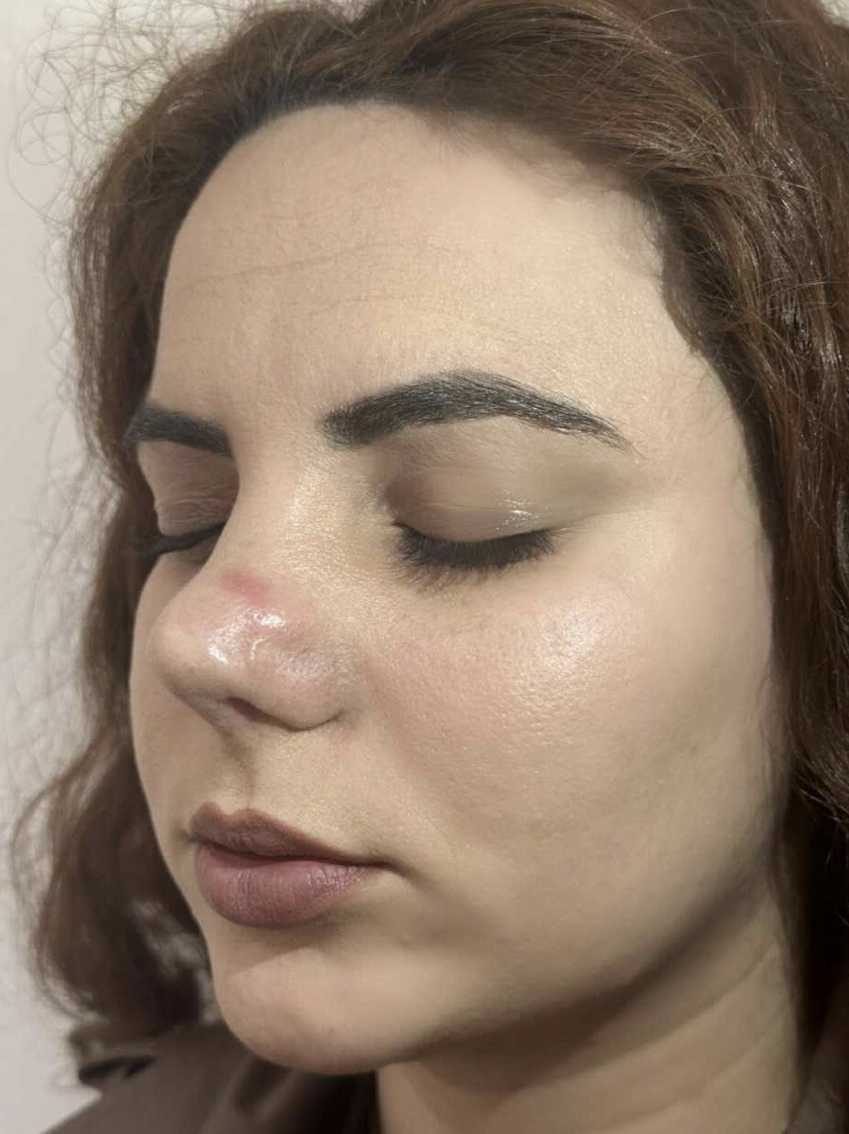 Девушка лишилась возможности нормально дышать из-за неудачной пластики Девушка лишилась возможности нормально дышать из-за неудачной пластики