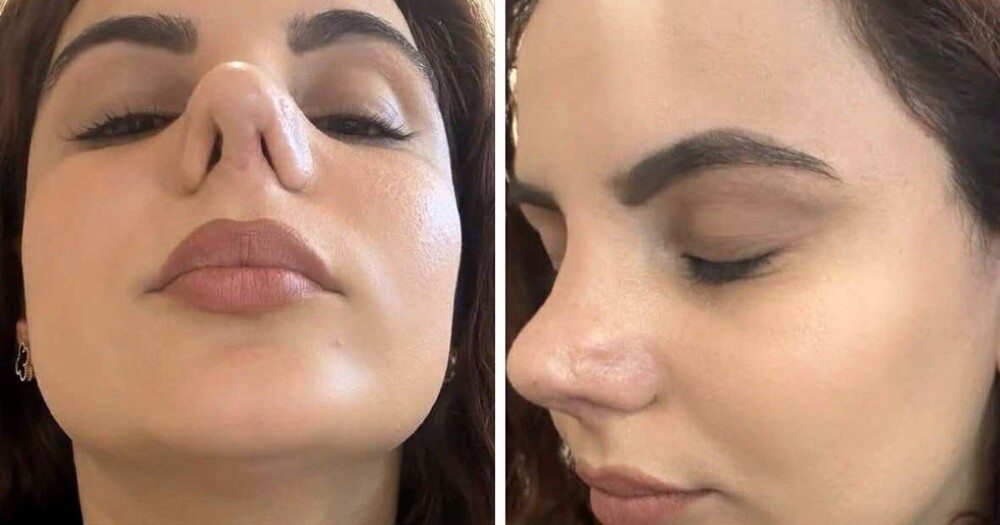 Девушка лишилась возможности нормально дышать из-за неудачной пластики Девушка лишилась возможности нормально дышать из-за неудачной пластики