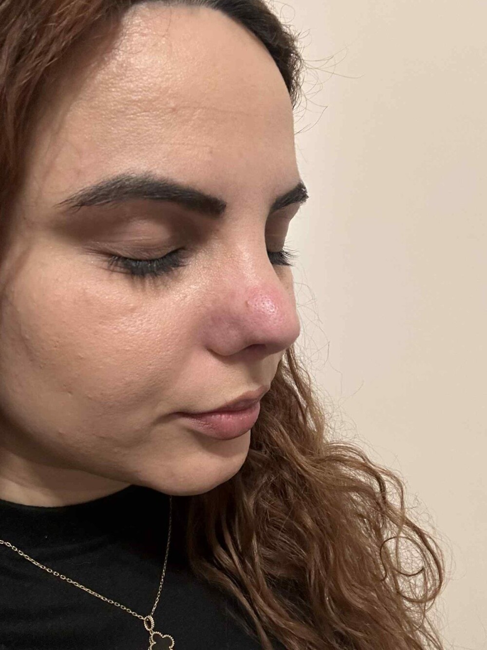 Девушка лишилась возможности нормально дышать из-за неудачной пластики Девушка лишилась возможности нормально дышать из-за неудачной пластики