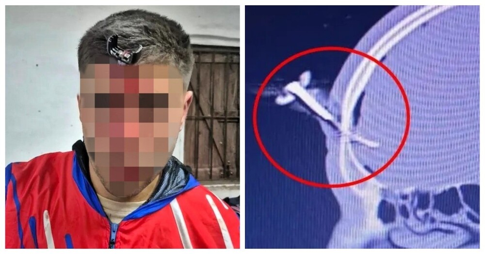 Ключ от машины застрял во лбу болельщика во время драки на матче