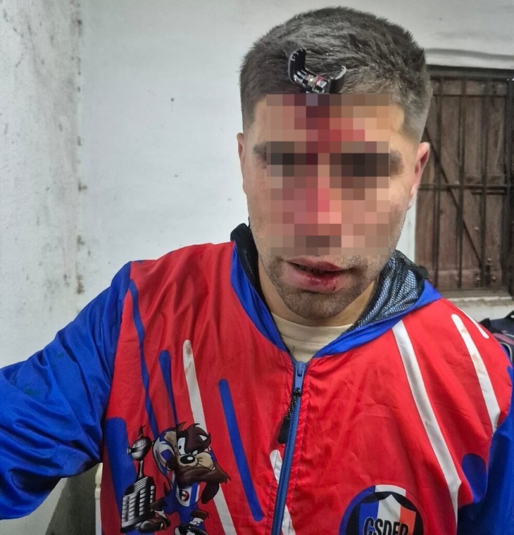 Ключ от машины застрял во лбу болельщика во время драки на матче