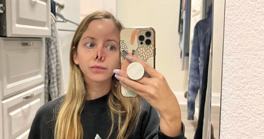 Женщине потребовалось 16 операций, чтобы восстановить нос после укуса собаки