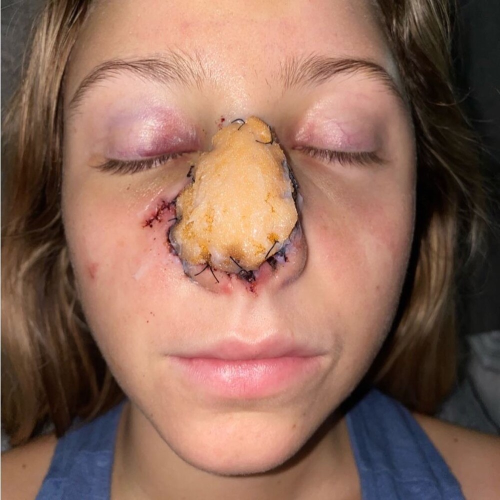 Женщине потребовалось 16 операций, чтобы восстановить нос после укуса собаки