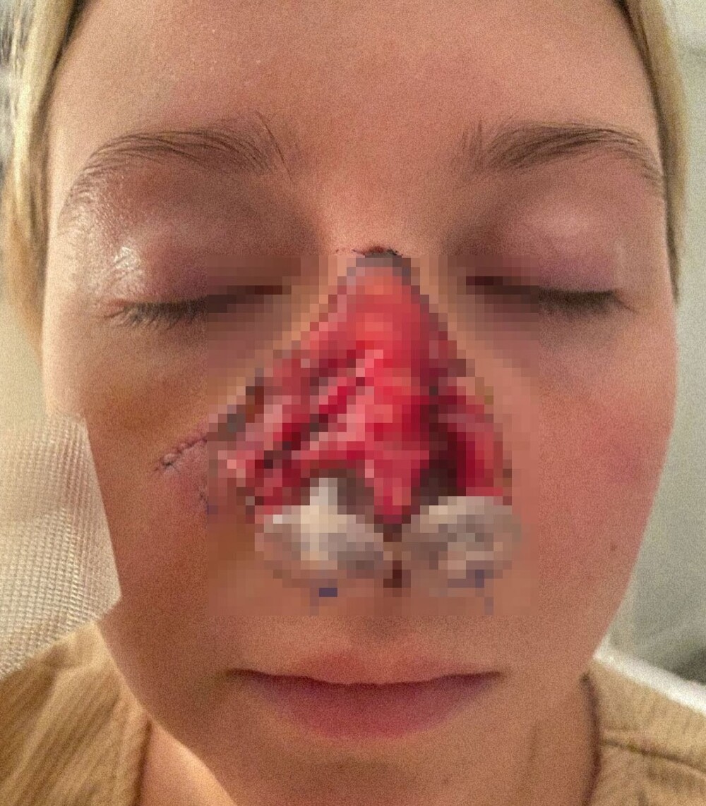 Женщине потребовалось 16 операций, чтобы восстановить нос после укуса собаки