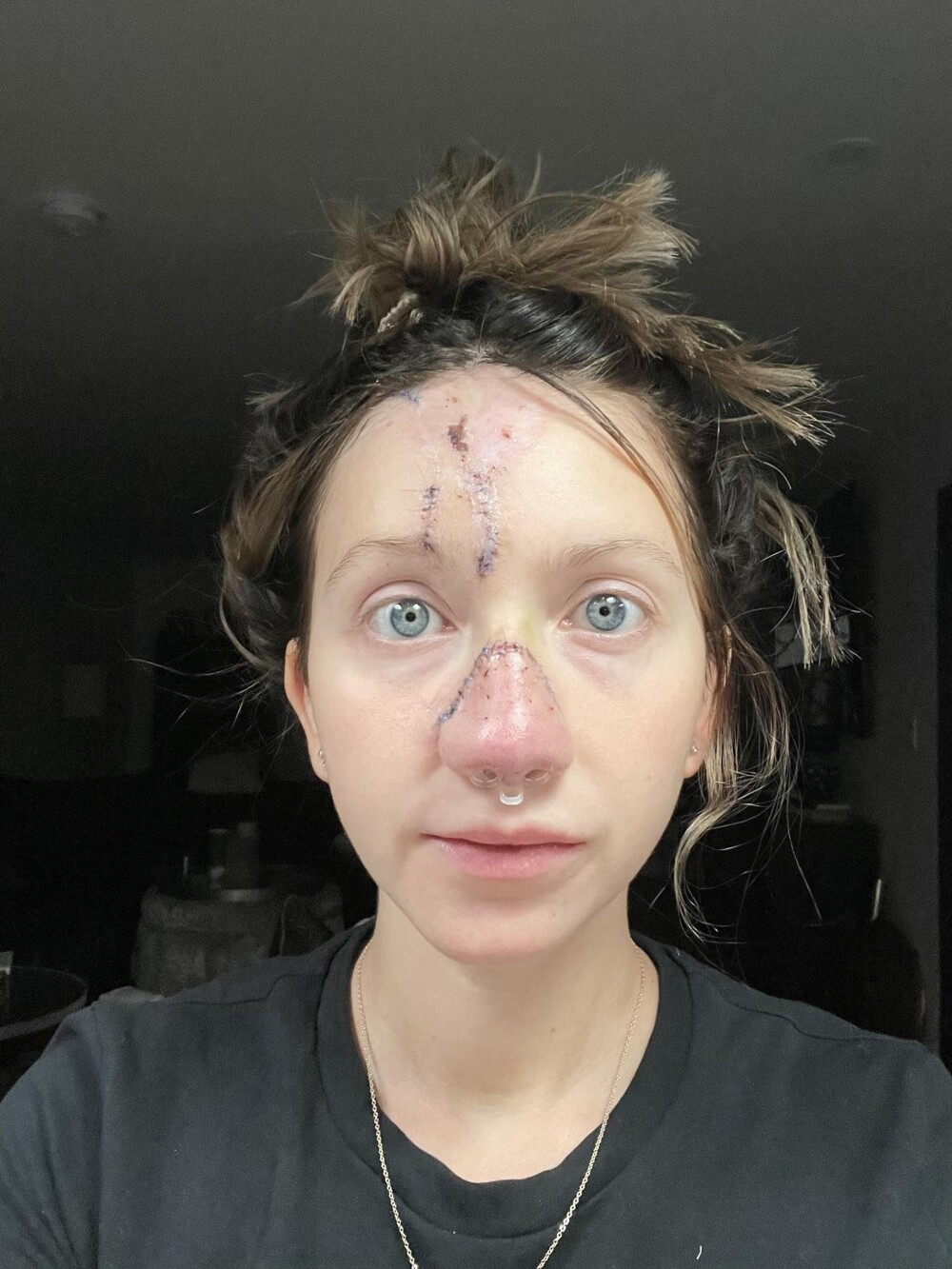 Женщине потребовалось 16 операций, чтобы восстановить нос после укуса собаки